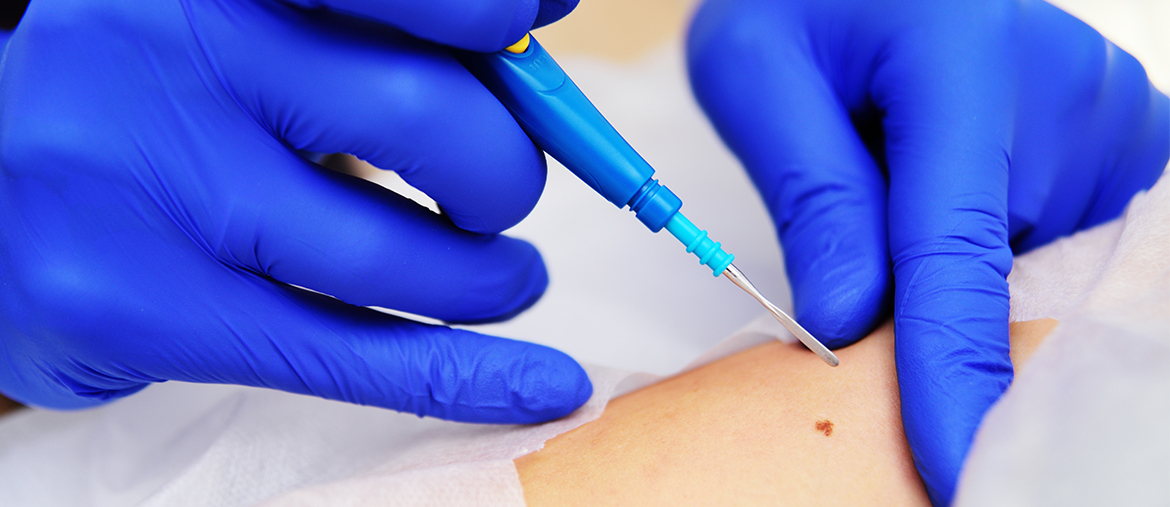  Skin Biopsy Treatment Services in Plano TX