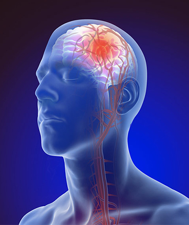 Stroke Services in Plano, TX  